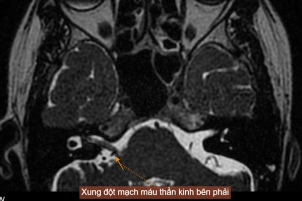 Chụp MRI xung đột thần kinh mạch máu
